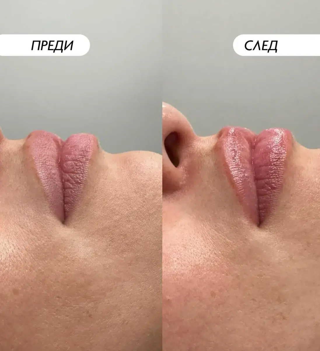 Снимка преди и след третиране на устните с Hydrafacial Perk Lip