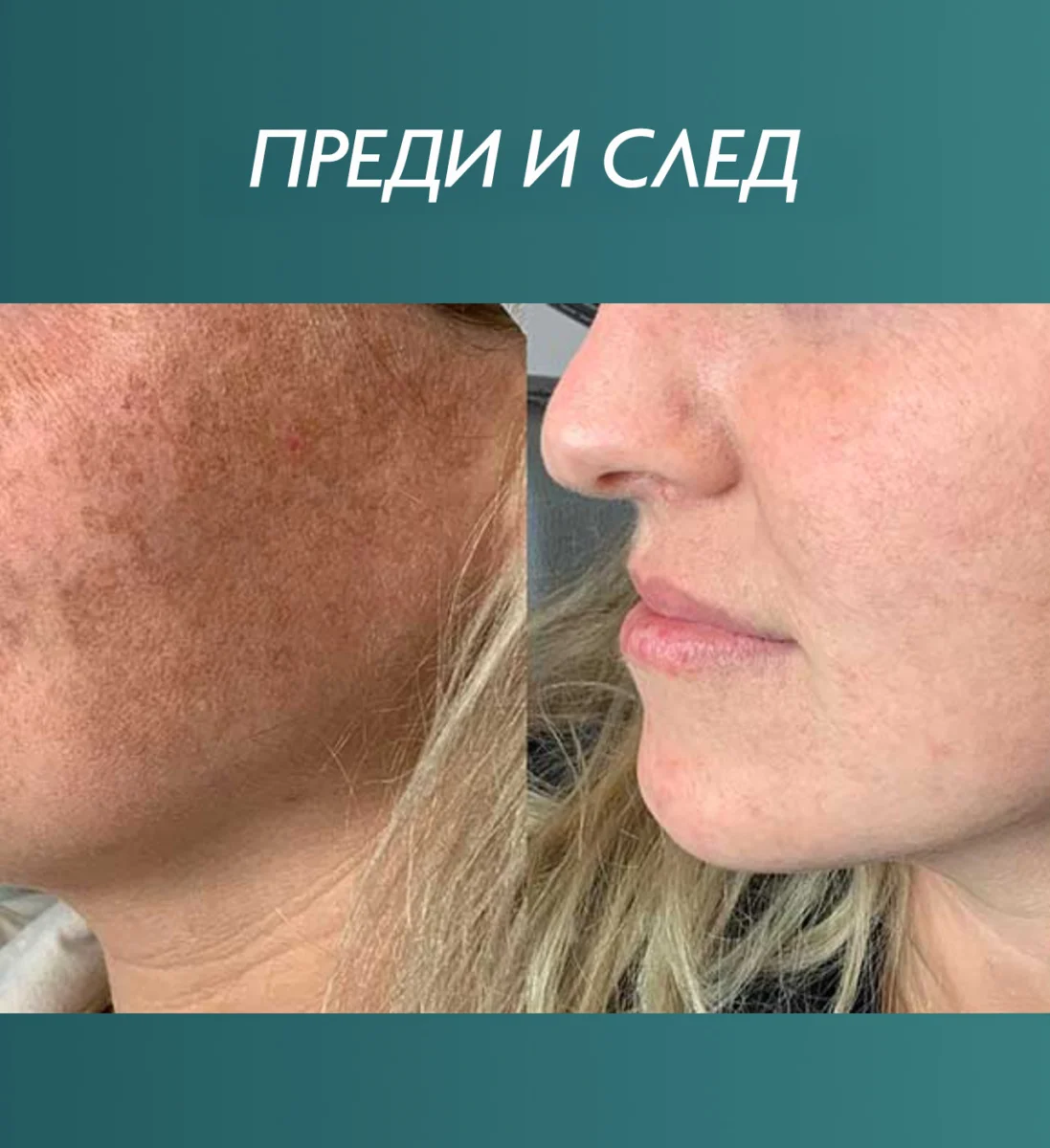 Снимка преди и след IPL терапия за пигментация на лицето