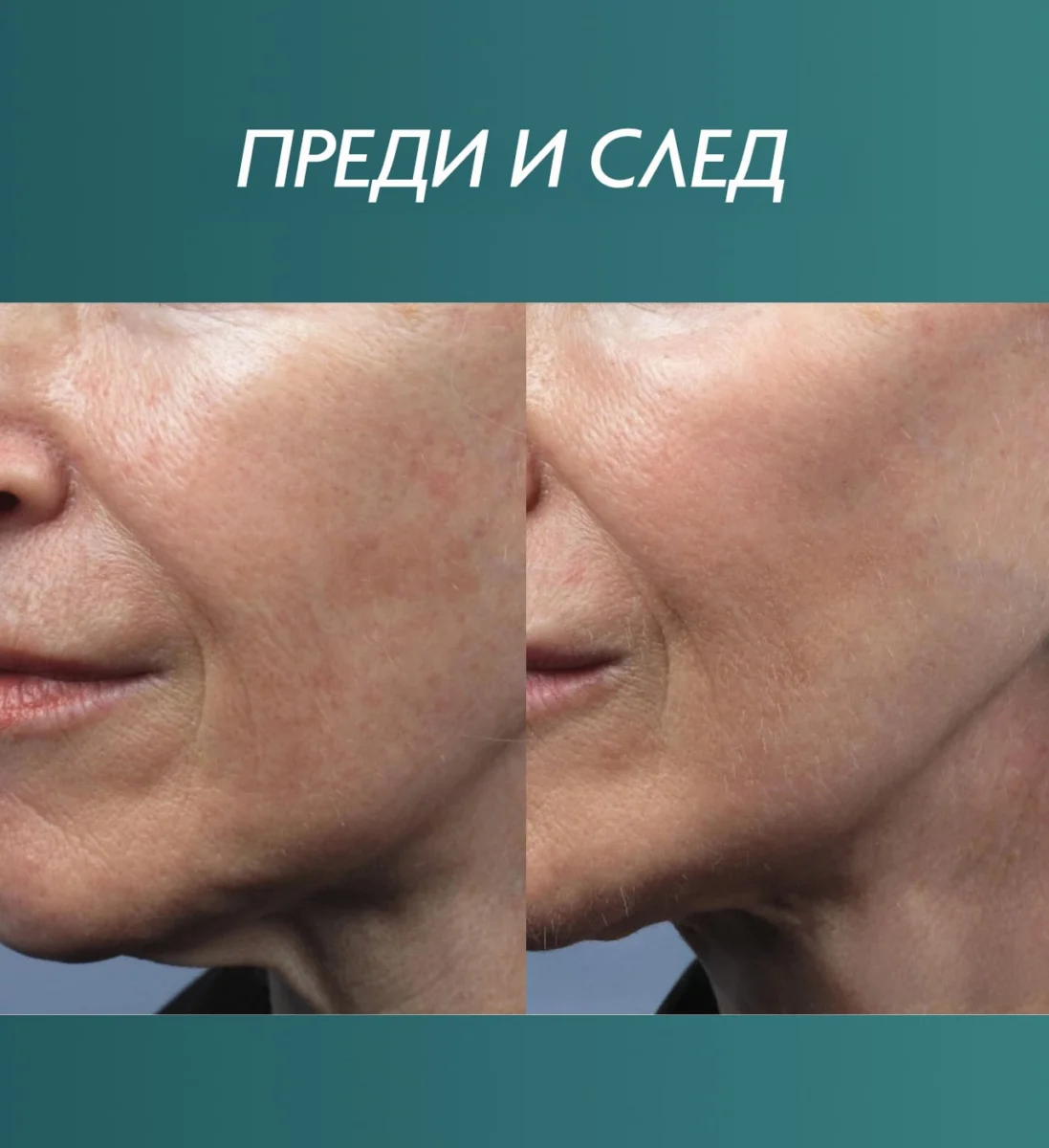 Снимка преди и след третиране на бръчки на лицето