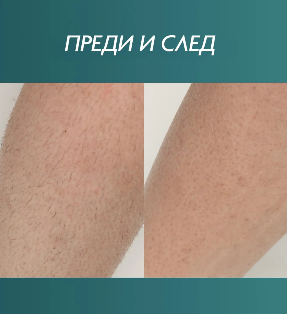 Снимка преди и след третиране на кожата на ръката