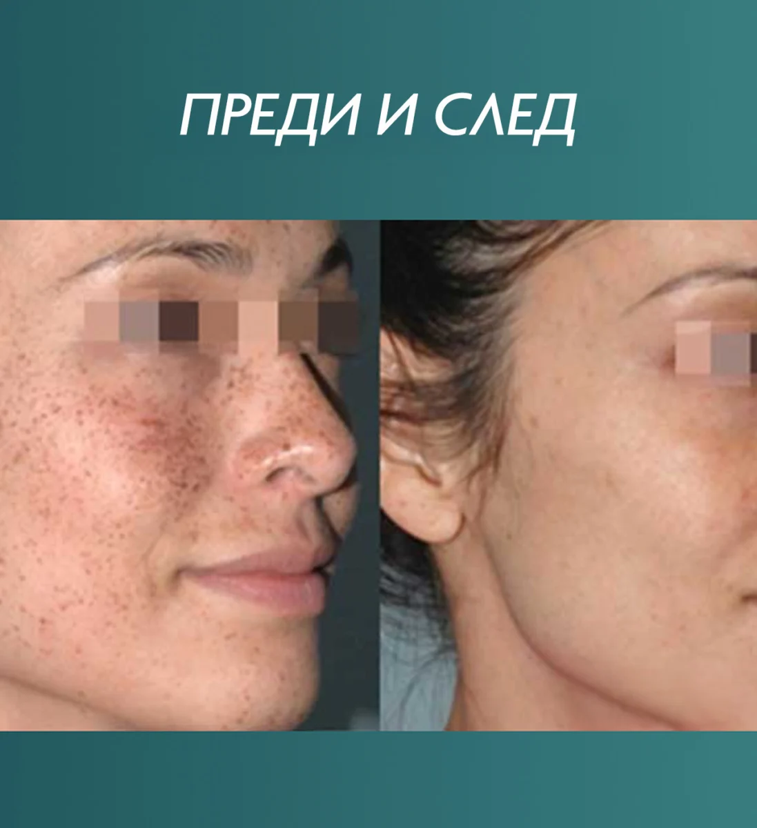 Снимка преди и след третиране на пигментация на лицето