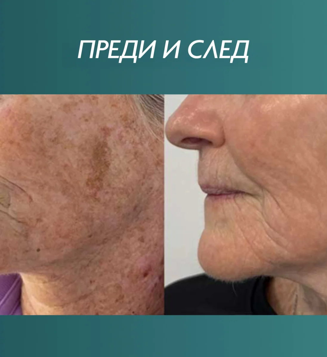 Снимка преди и след третиране на пигментация и стареене на кожата