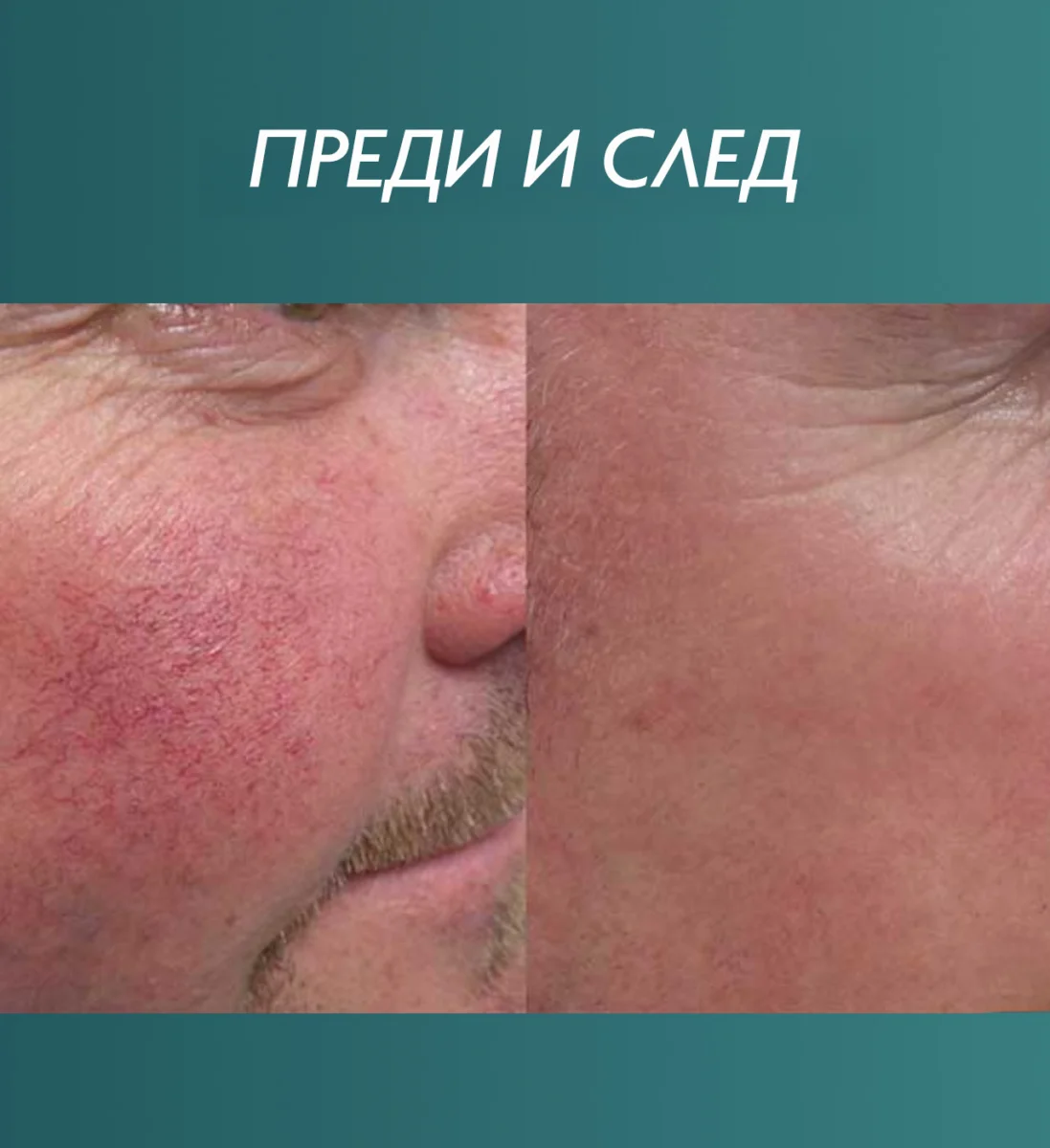 Снимка преди и след третиране на зачервяване на лицето