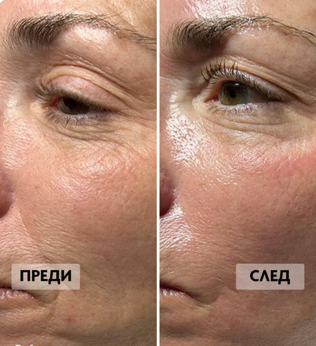 Преди и след на фини линии и бръчки.
