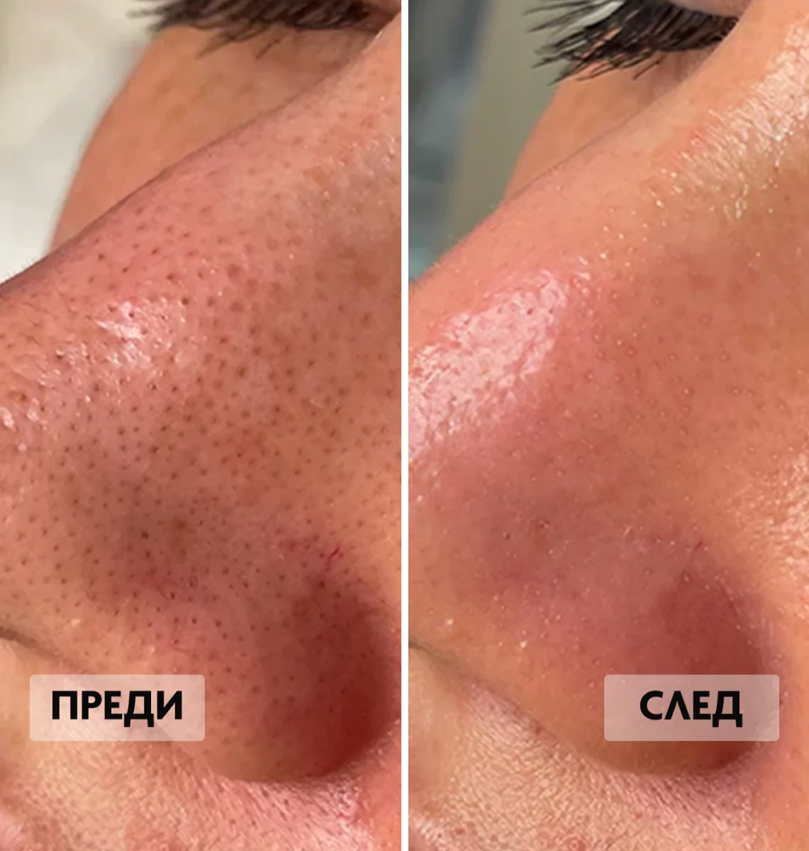 Преди и след на почистване на широки пори на нос.