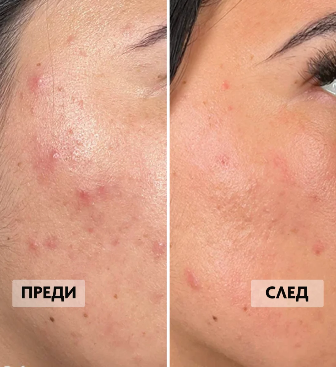 Преди и след на състоянието на акнеична кожа.