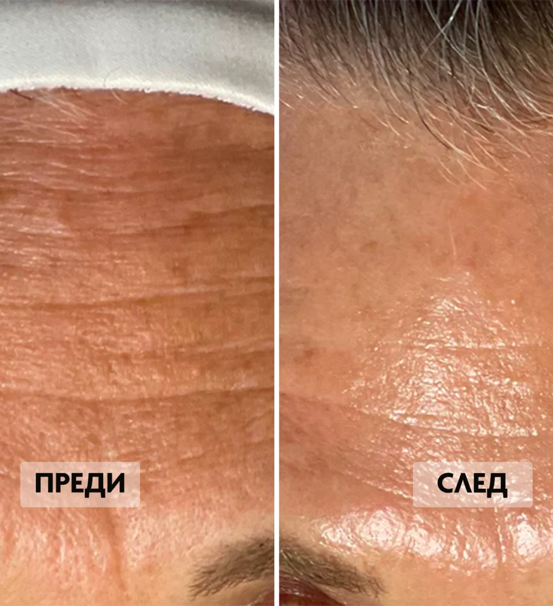 Преди и след на третиране на признаци на стареене по челото.