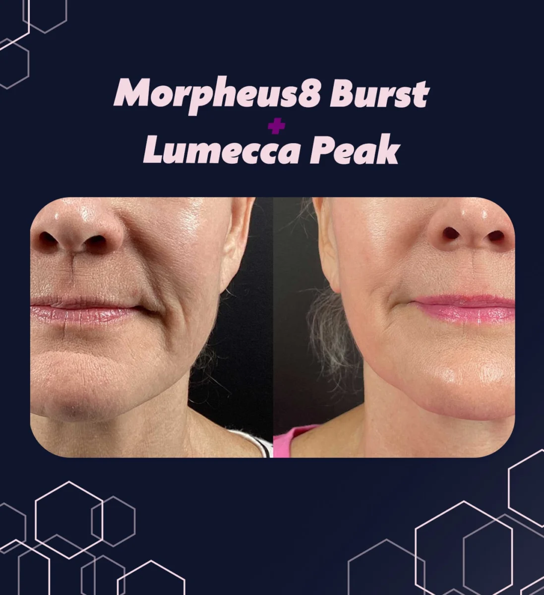 Промоционален банер за Morpheus8 Burst и Lumecca Peak - снимка преди и след