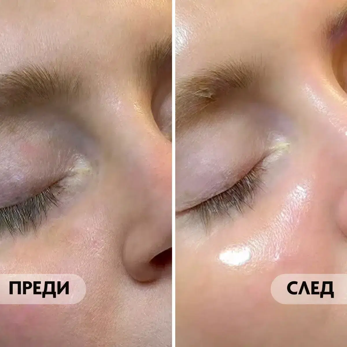 Преди и след на суха и дехидратирана кожа.