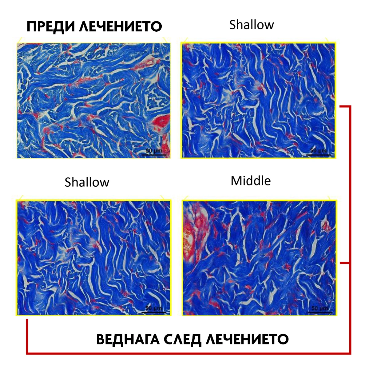 Термографски анализ на кожата преди и веднага след XERF терапия
