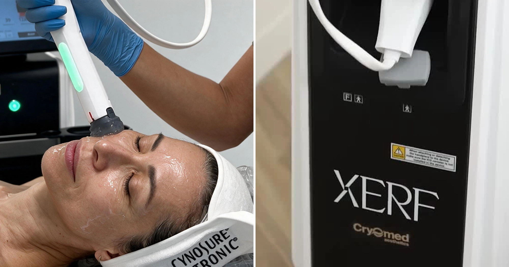 процедура за XERF или Morpheus8 в Естетичен център Молекула